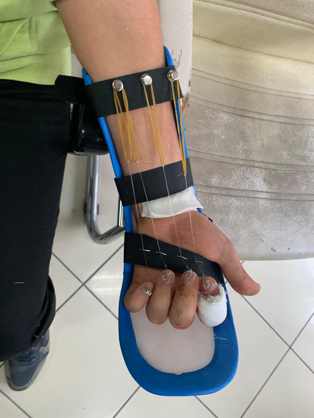 Fleksör Tendon Kesisi Splinti