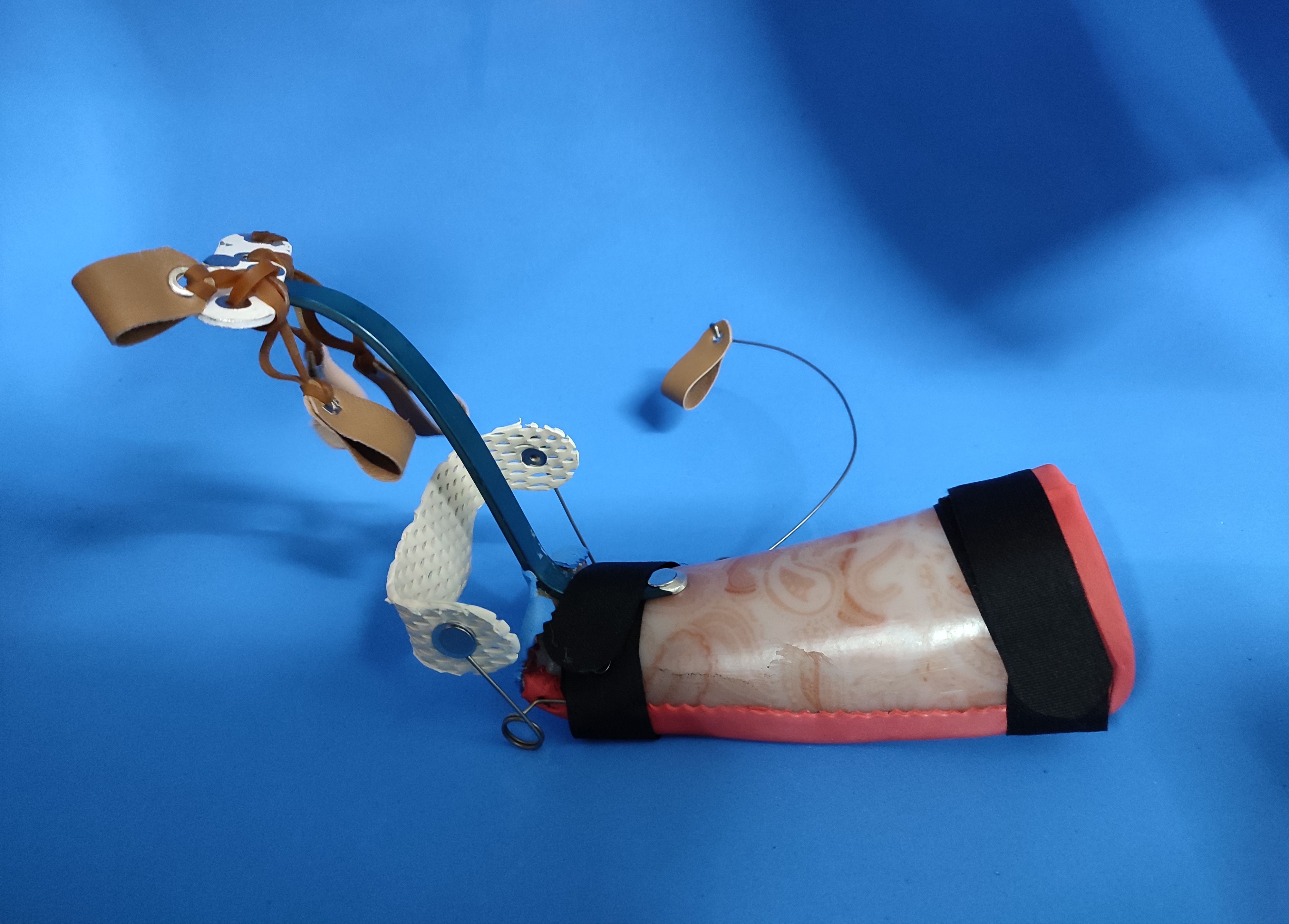 Ekstansör Tendon Kesisi Splinti